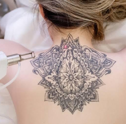 Tattoo Removal - Best Dermatologists and trichologists in Bangalore |  Haircosmos