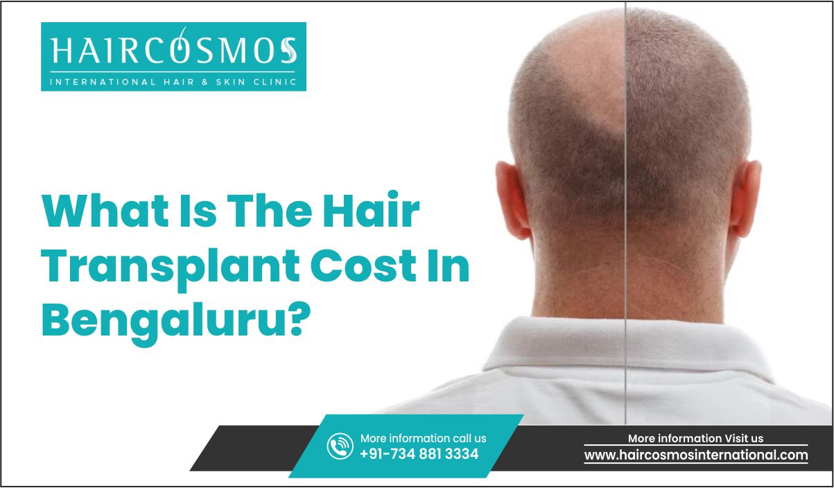 Affordable Hair Transplant Cost in Bengaluru - Haircosmos International